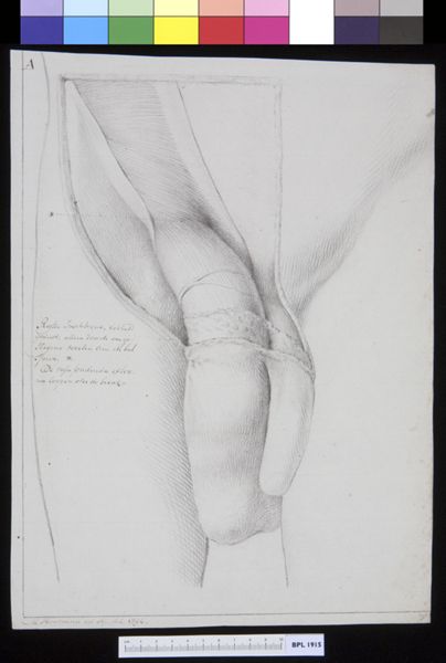 M Houtman, Inguinal hernia