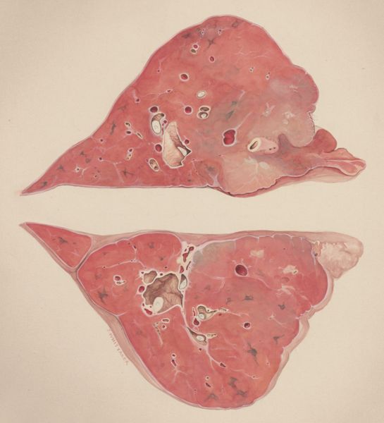 J Wetselaar-Whittaker, Lung tissue