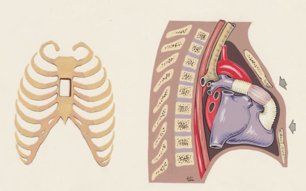 J Tinkelenberg, Thorax surgery