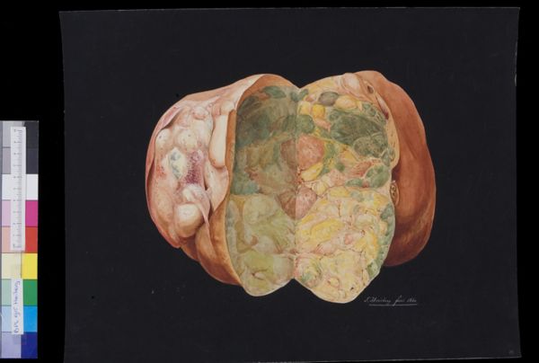 Tiemen Hooiberg, Pathology, liver