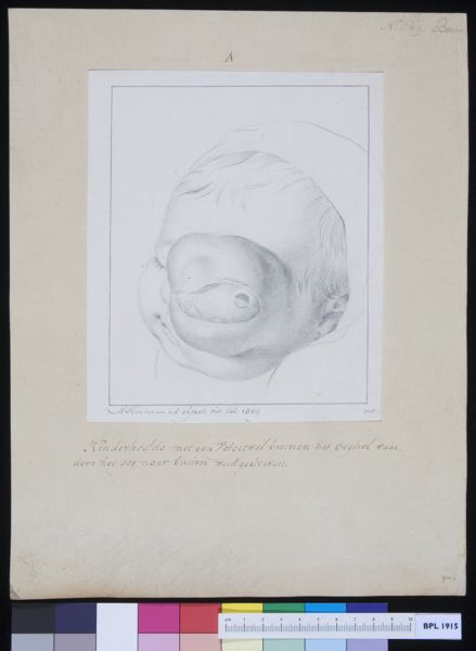 M Houtman, Child with tumor in its eye