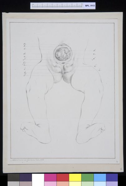 M Houtman, Intestines and genitals of a child, umbilical tumor