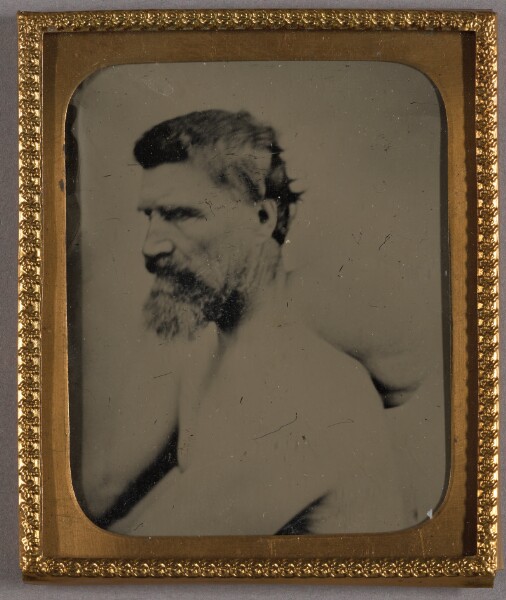 Unknown, [Portrait of a Bearded Man with Abnormal Hump Growth on Back]