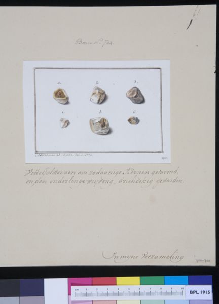 M Houtman, Gallstones