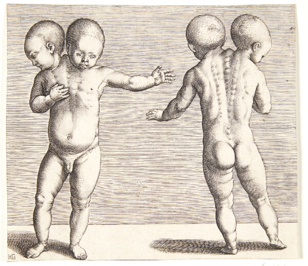 Hendrick Goltzius, Et vanskabt barn med to hoveder