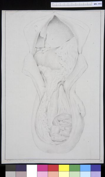 M Houtman, Hernia inguinalis