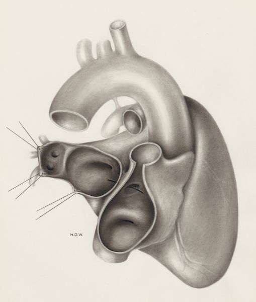 H.G Wetselaar, Heart
