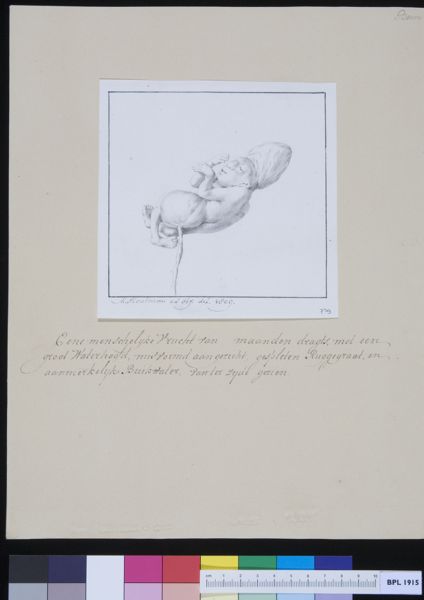 M Houtman, Deformed fetus