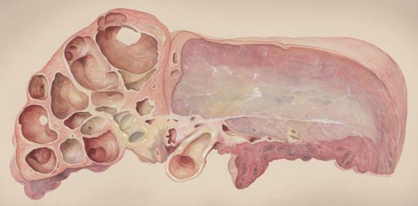 J Wetselaar-Whittaker, Lung tissue
