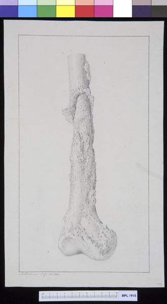 M Houtman, Infected bone (tibia?)