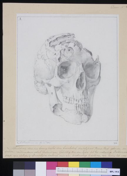 M Houtman, Fractured skull