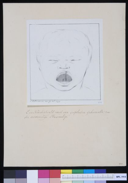 M Houtman, Child with cleft palate