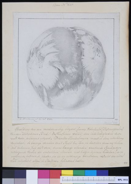M Houtman, Hydrocephalus
