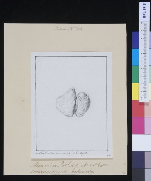 M Houtman, Stone from the bladder
