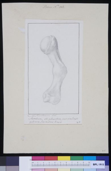 M Houtman, Bone of the arm: fracture
