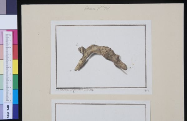 M Houtman, Gallstones