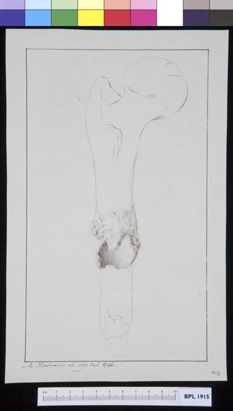M Houtman, Infected bone (femur)