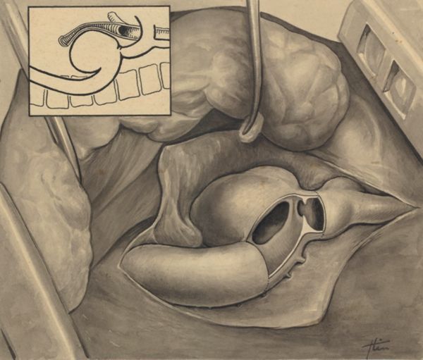 J Tinkelenberg, Thorax surgery