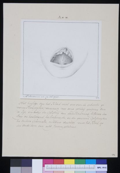 M Houtman, Child with cleft lip, healed before birth