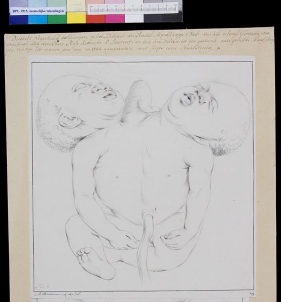 M Houtman, Conjoined twins