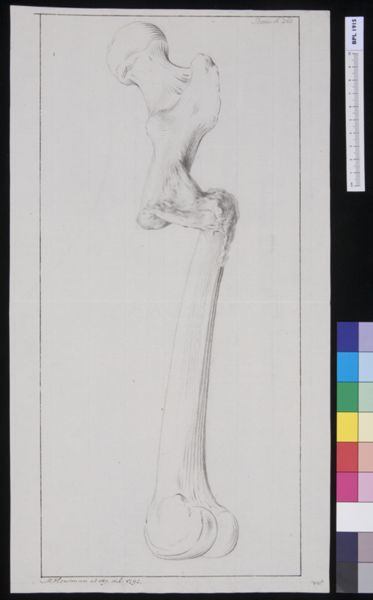 M Houtman, Femur: fracture