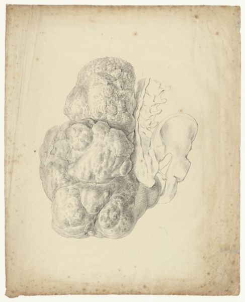 A Bonn, Tumor growing from a man's buttocks, attached to the pelvis
