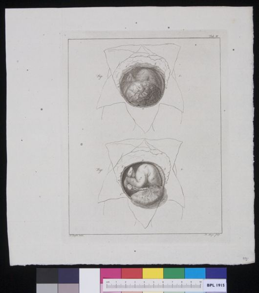 R Muys, Abdomen with position of fetus