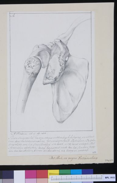 M Houtman, Shoulder bones: fracture