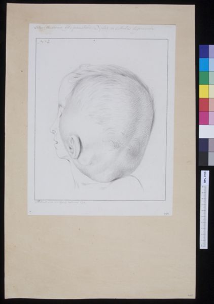 M Houtman, Osteo-steatoma in a child's head