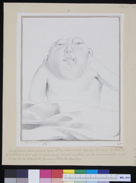 M Houtman, Deformed child
