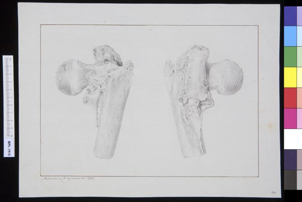 M Houtman, Infected bone (femur)