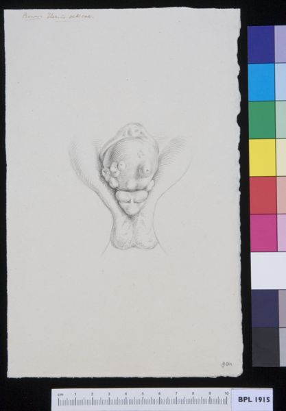A Bonn, Male genitals, deformed