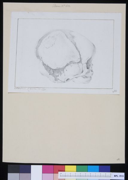 M Houtman, Skull of a child with hydrocephalus