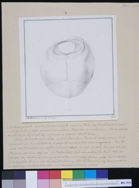 M Houtman, Skull of a child, hernia