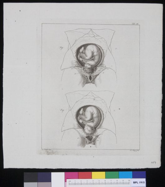 R Muys, Abdomen with position of fetus
