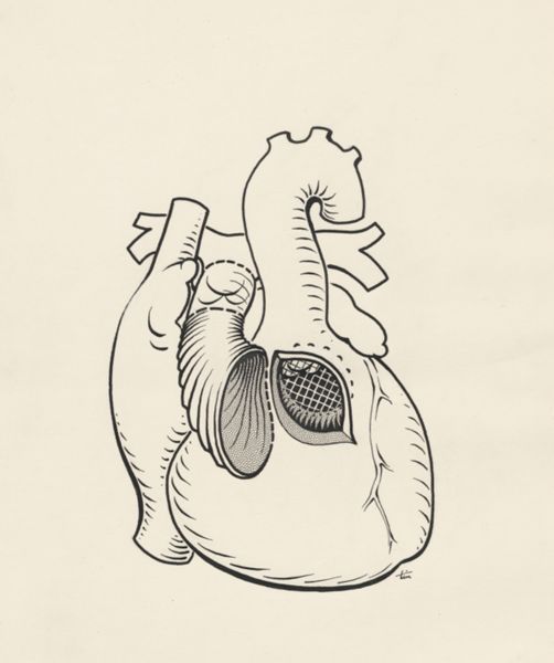 J Tinkelenberg, Heart surgery