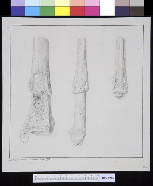 M Houtman, Infected bone (tibia?)
