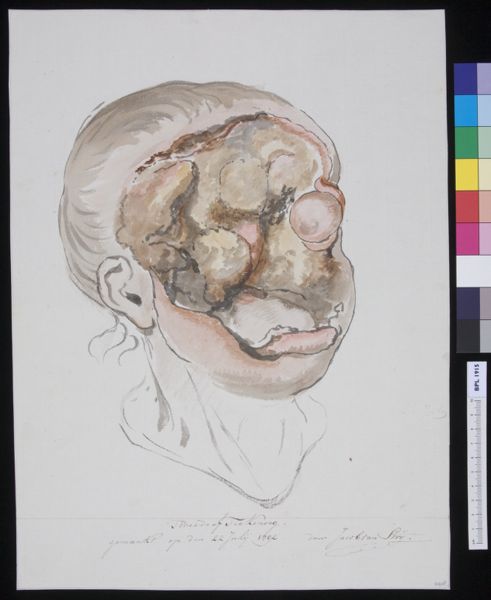 Jacob van Strij, Man with severely deformed face
