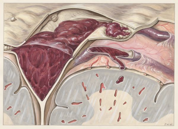 J Wetselaar-Whittaker, Sick human tissue relating to thrombosis
