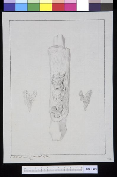 M Houtman, Bone infection
