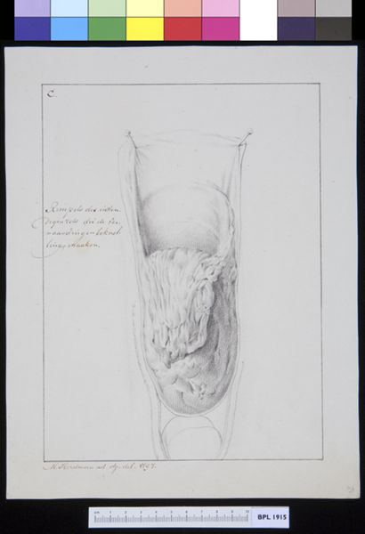 M Houtman, Inguinal hernia