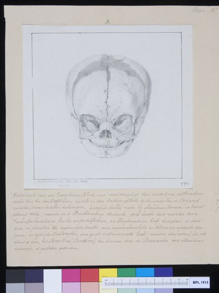 M Houtman, Skull of a child with hydrocephalus
