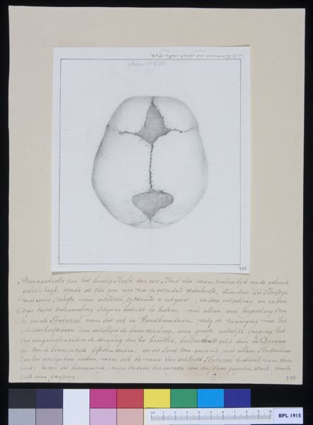 M Houtman, Skull of a child with hydrocephalus